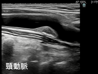 頸動脈超音波検査